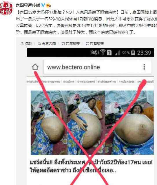 17胞胎 泰媒辟谣：“52岁泰国大妈怀17胞胎”照片系胆囊病人旧照