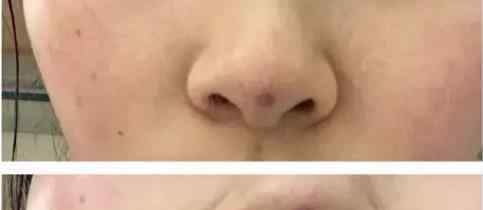 线雕鼻子修复全过程照片鼻子做完埋线常见问题、鼻子线雕后的并发