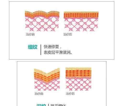 欧州做面部微雕提升面部美容护肤和其他细胞再生医工艺