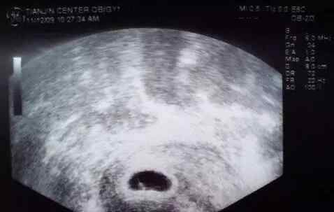 怀孕多长时间能够见到胎芽胎心