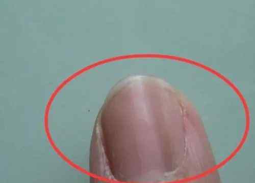 甲黑线 黑色变的甲黑线到底是怎么回事？