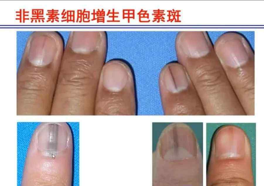 甲黑线 黑色变的甲黑线到底是怎么回事？