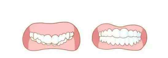 牙齿深覆合、深覆盖有什么不同?