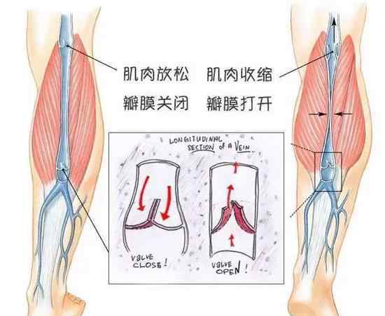 出现静脉曲张怎么办 针对跑者小腿静脉曲张 你该怎么办？