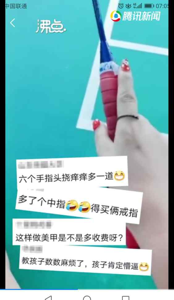 女子天生12根手指自嘲六指琴魔是真的吗12根手指头长什么样