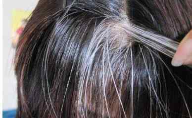 中年白发怎么治 如何治疗白发 治疗白发的最好方法介绍