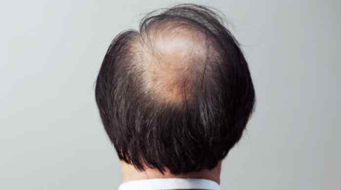 柯哲娴 18岁高中生头发掉了一半 原因就在其父亲茂密头发背后