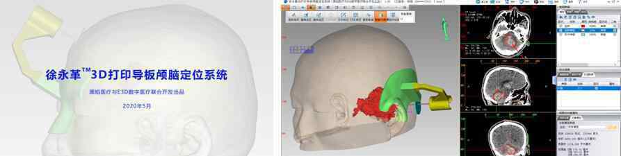 徐永革 3D打印导板辅助脑出血微创手术    黑焰与徐永革团队助力基层医院