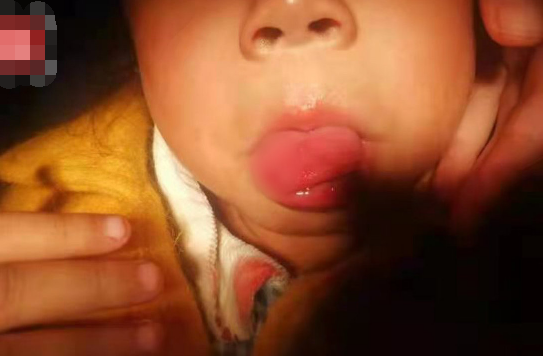 4岁女童幼儿园摔倒致舌头撕裂伤 究竟是怎么一回事