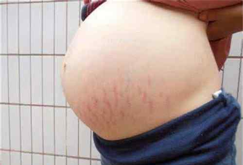 长妊娠纹了怎么办 最后一个月长妊娠纹了怎么办 妊娠纹会自动消失吗