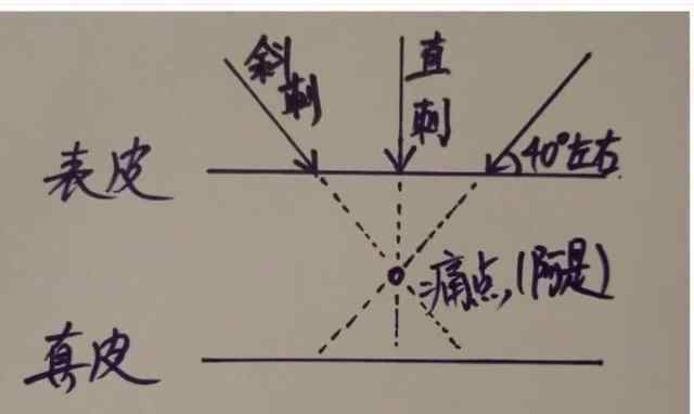 钍怎么读 黄帝内针怎么扎？说说我理解的进针方法