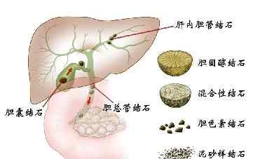 泥沙样胆结石如何治疗 泥沙型胆结石怎么治疗