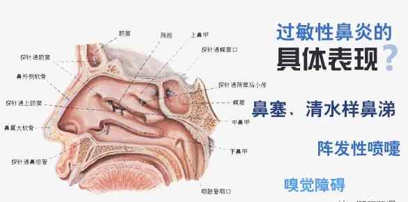 过敏性鼻炎用药 过敏性鼻炎的7款药物+5个联合用药方案