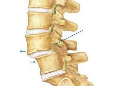腰椎滑脱的症状表现 出现这些症状，就可能是腰椎滑脱!