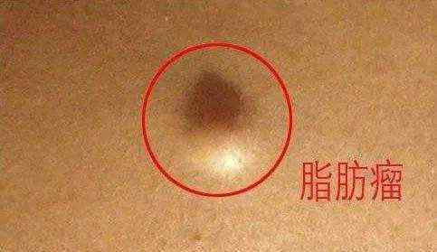 身上起红疙瘩不疼不痒 身上出现这种小疙瘩，不痛不痒但是不要忽视