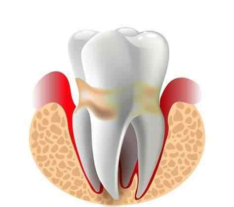 牙周炎牙齿松动 牙齿松动，并且牙龈经常发炎，怎么办？口腔医生给你说一说