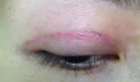 在杭州双眼皮割成这样，你还怎么去见人？