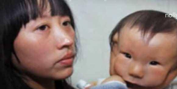 患有天生横向面裂畸形症状 孩子像戴面具