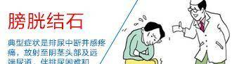 这些症状就是膀胱结石