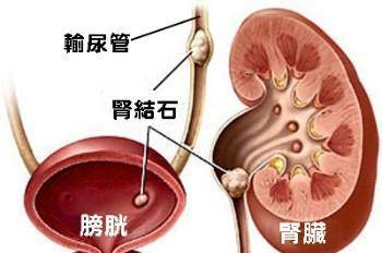 这些症状就是膀胱结石