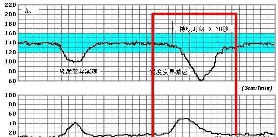 什么是NST?