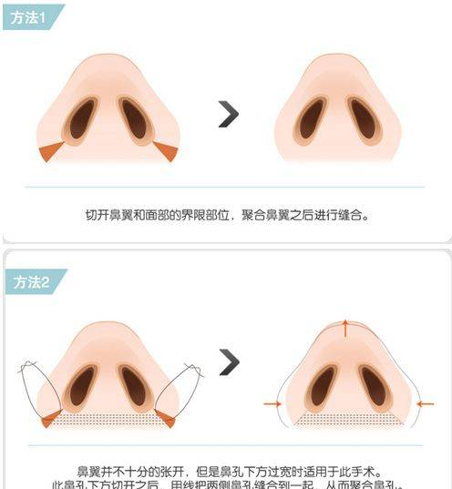 韩国WILL魏鼻子告诉你鼻翼下垂该怎么办？