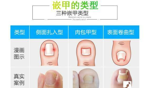 脚趾甲长到肉里怎么办？这个实用办法帮你搞定！
