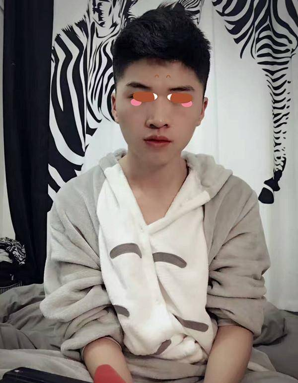 自体脂肪填充苹果肌，男生也是爱美的，我脸部越来越有轮廓了