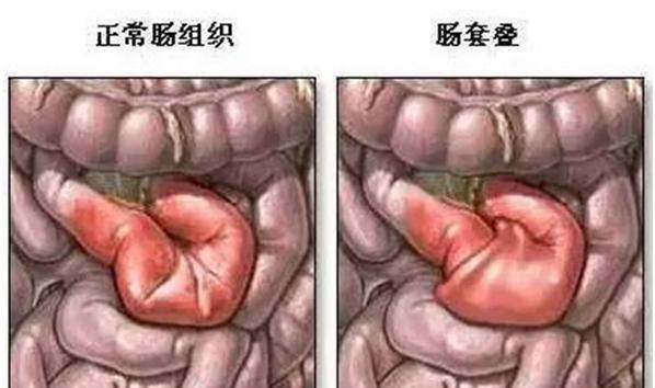 一位妈妈的亲身经历：肠套叠差点要了我孩子的命！