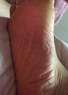 脚气怎么根治？治脚气的偏方？脚气的治疗方法哪些有效？治脚气最有效的方法