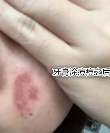 不明白为什么有人会用牙膏涂脸来祛痘痘？