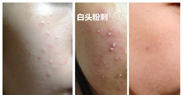 不明白为什么有人会用牙膏涂脸来祛痘痘？
