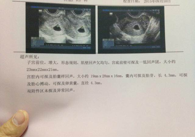看B超数据判断宝宝性别!10个有9个说准!你想知道吗?