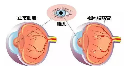 眼底病常见的7种类型 你都需要了解清楚！