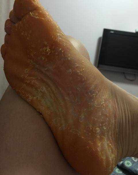 我来说说自己如何去除脚气的过程