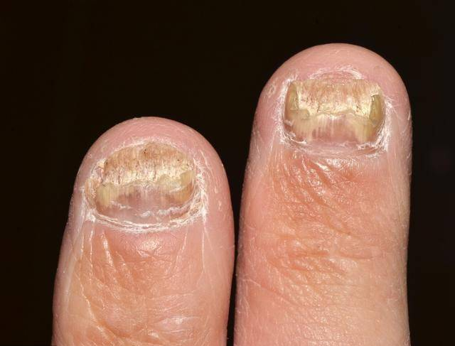 灰指甲危害大主要表现在以下几个方面