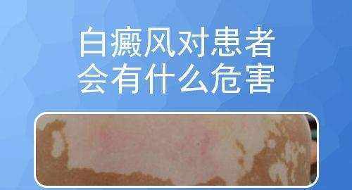 白癜风危害这么多 你还敢拿它不当回事吗