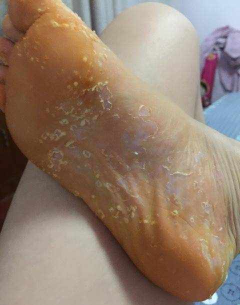 我来说说自己如何去除脚气的过程