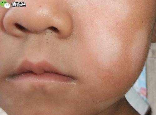 仔细看看，你家孩子脸上有这种白斑吗？