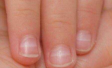 手指甲有白点暗示这4种疾病，很多人都不知道。