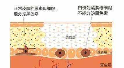 脸上很多雀斑，用激光能祛斑吗？