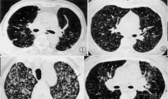 熟记这些 CT 表现，一眼识破转移性肺癌