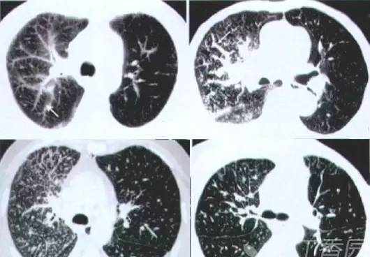 熟记这些 CT 表现，一眼识破转移性肺癌