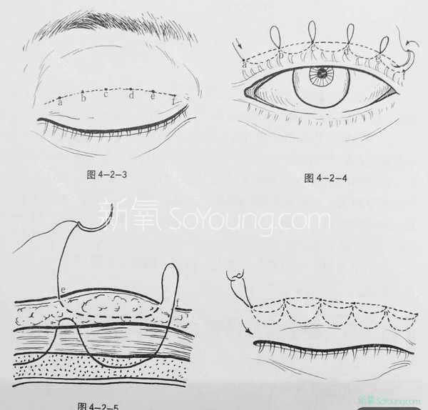 埋线双眼皮必看扫盲帖