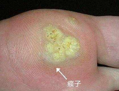 鸡眼还是瘊子，不要再搞错