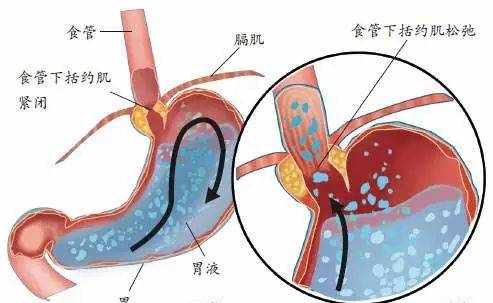 早上起来为什么会恶心干呕？原来是这三种原因 ！！！