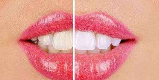 牙齿发黄变白小窍门 牙齿发黄是什么原因 牙齿发黄怎么变白