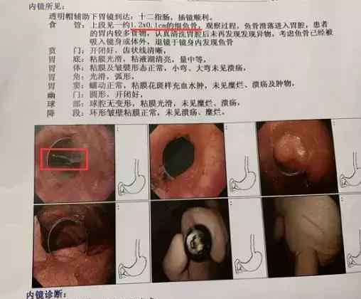 鱼刺卡在喉咙会溶解吗 被鱼刺卡了两天，花了两千块！被鱼刺卡喉后，她后悔做了这一件事