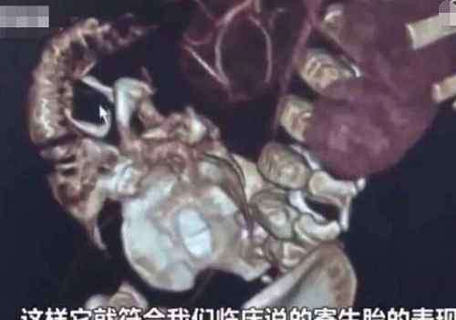 寄生胎 男婴腹中藏寄生胎 寄生胎什么意思可以存活吗