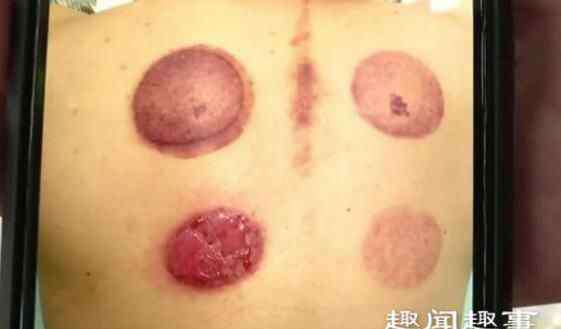 男子养生馆 杭州一男子在养生馆拔火罐,结果几个罐刚放背上,听到女技师一句话后他报警了